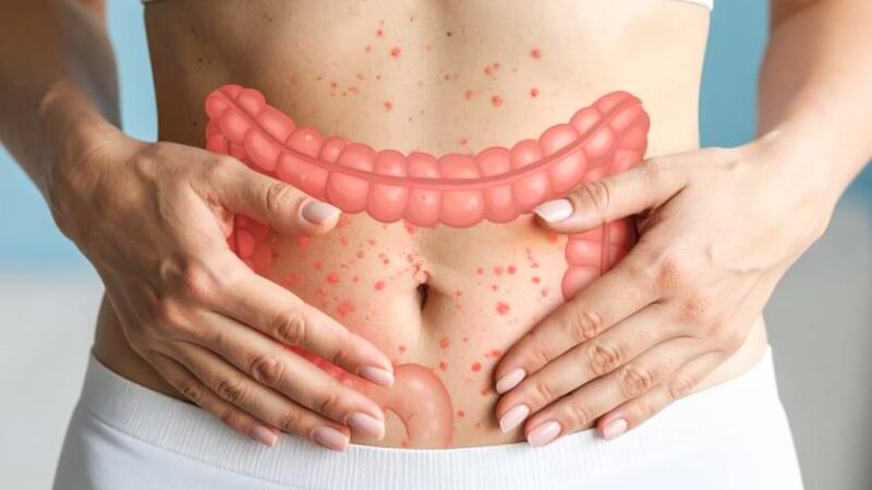 Egzama ve Bağırsak Sağlığı İlişkisi